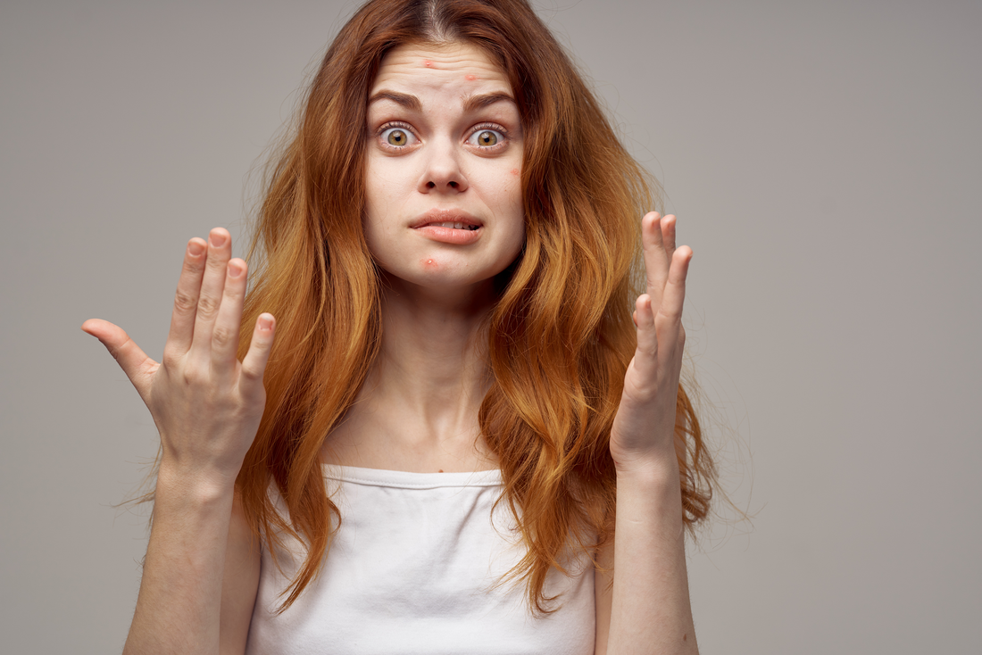 Hilfe! Mehr Pickel nach dem Peeling? Alles über das Phänomen „Skin Purging“