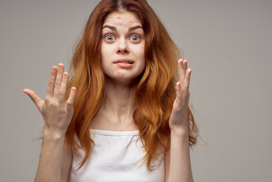 Hilfe! Mehr Pickel nach dem Peeling? Alles über das Phänomen „Skin Purging“